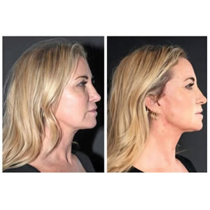 Thread lift Meg Mathews