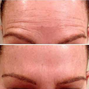 anti-wrinkle
