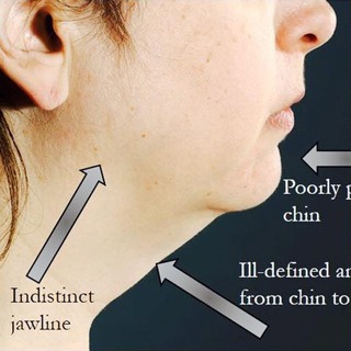 chin augmentation