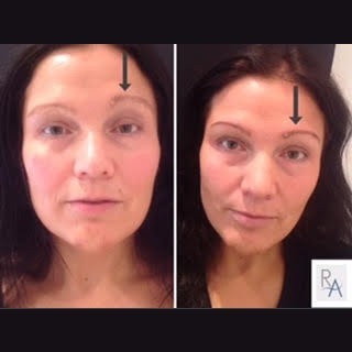 eyebrow reshaping