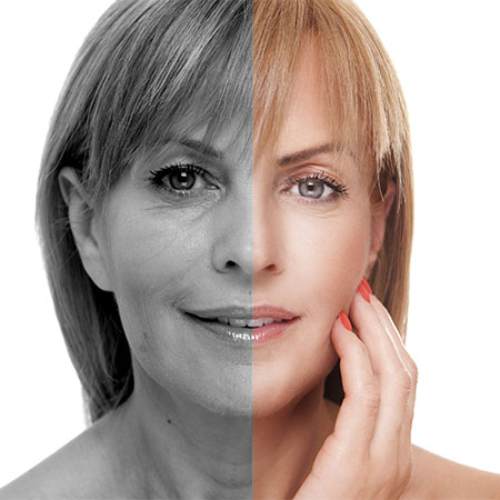 laser skin resurfacing Poole