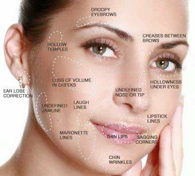 botox or fillers