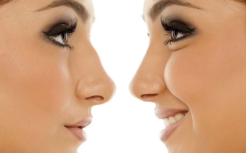 4 ways to transform your nose without a rhinoplasty