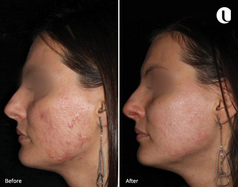 M22-Laser-Machine-Before-and-After-2