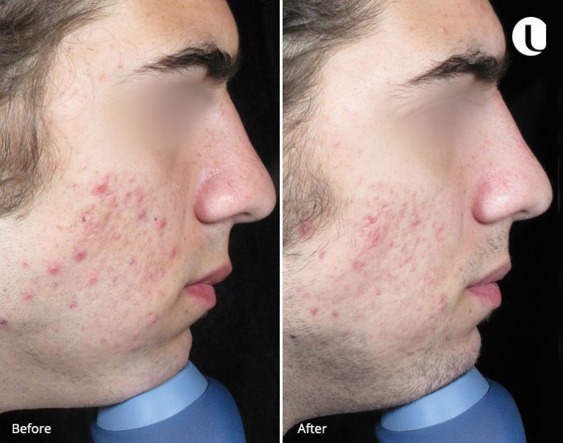 M22-Laser-Machine-Before-and-After