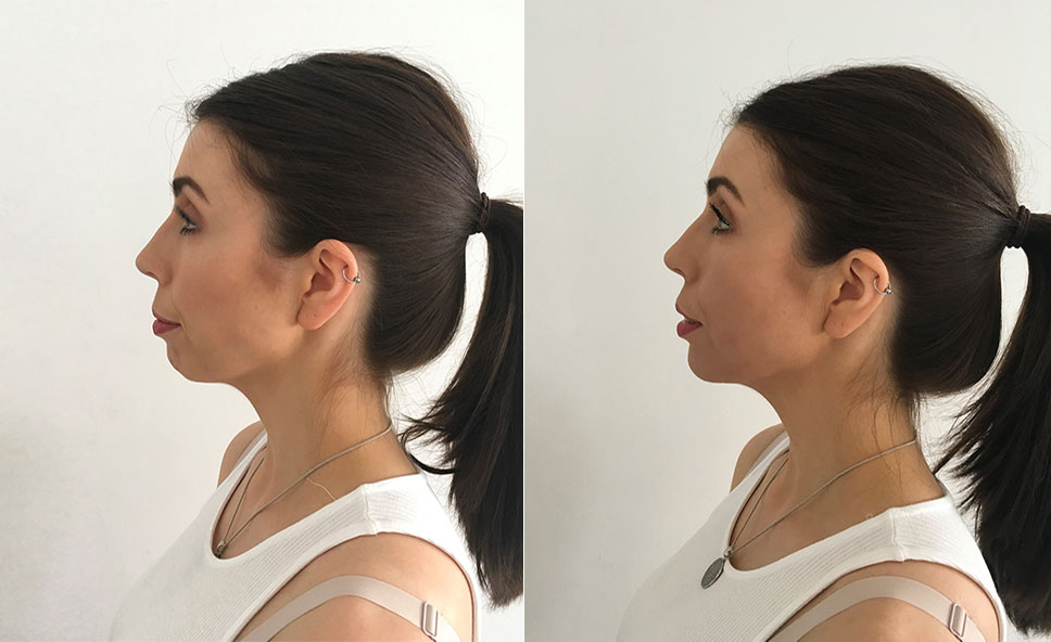 Chin Fillers