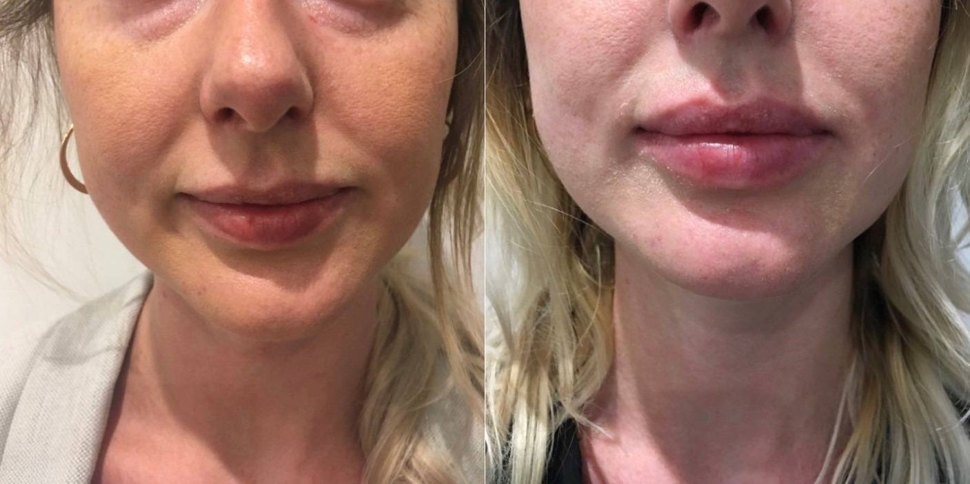 River Lip Experience at River Aesthetics