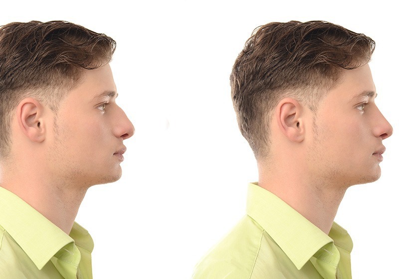 nose-reshaping