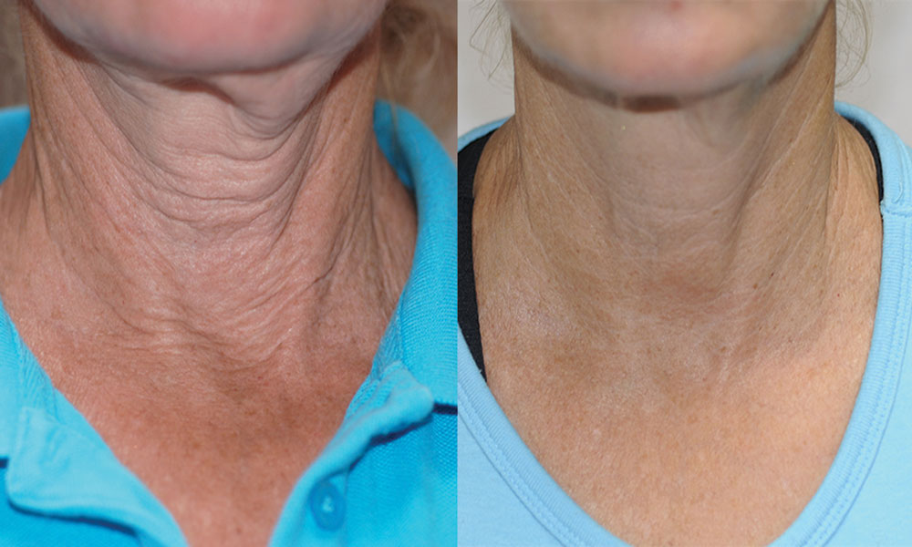 BTL-Elite_nec Exilis