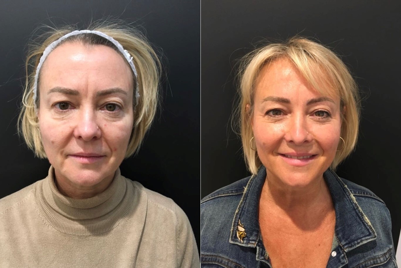 sagging jowls corrected with a thread lift at River Aesthetics