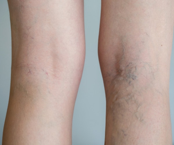 Varicose Veins - River Aesthetics