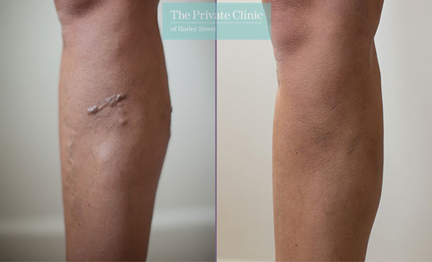 Varicose Veins - River Aesthetics
