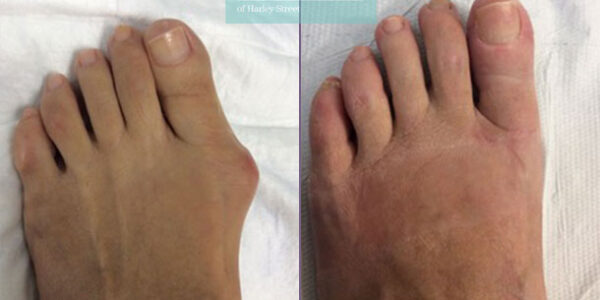 Bunion removal, River Aesthetics