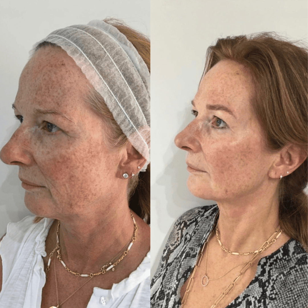 Before and After Thread Lift Treatment