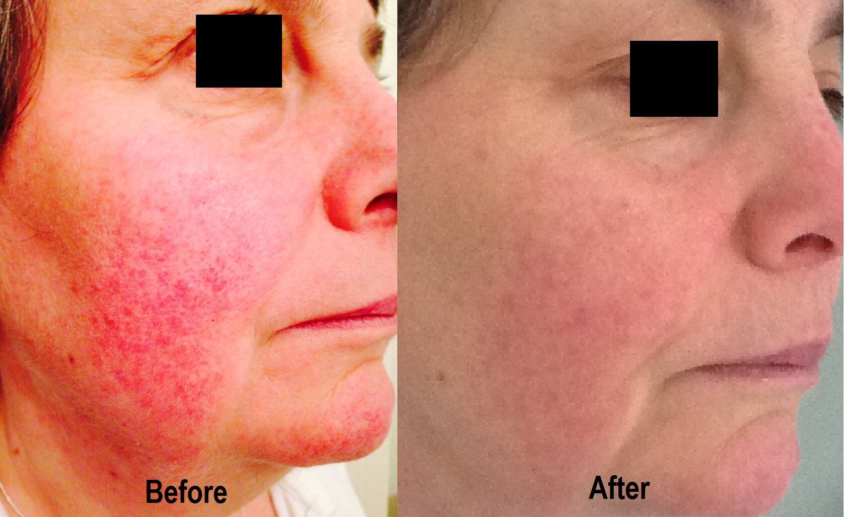 Enerpeel before and after