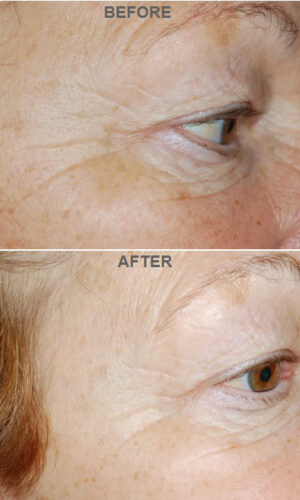 Enerpeel Eye and Lip 3