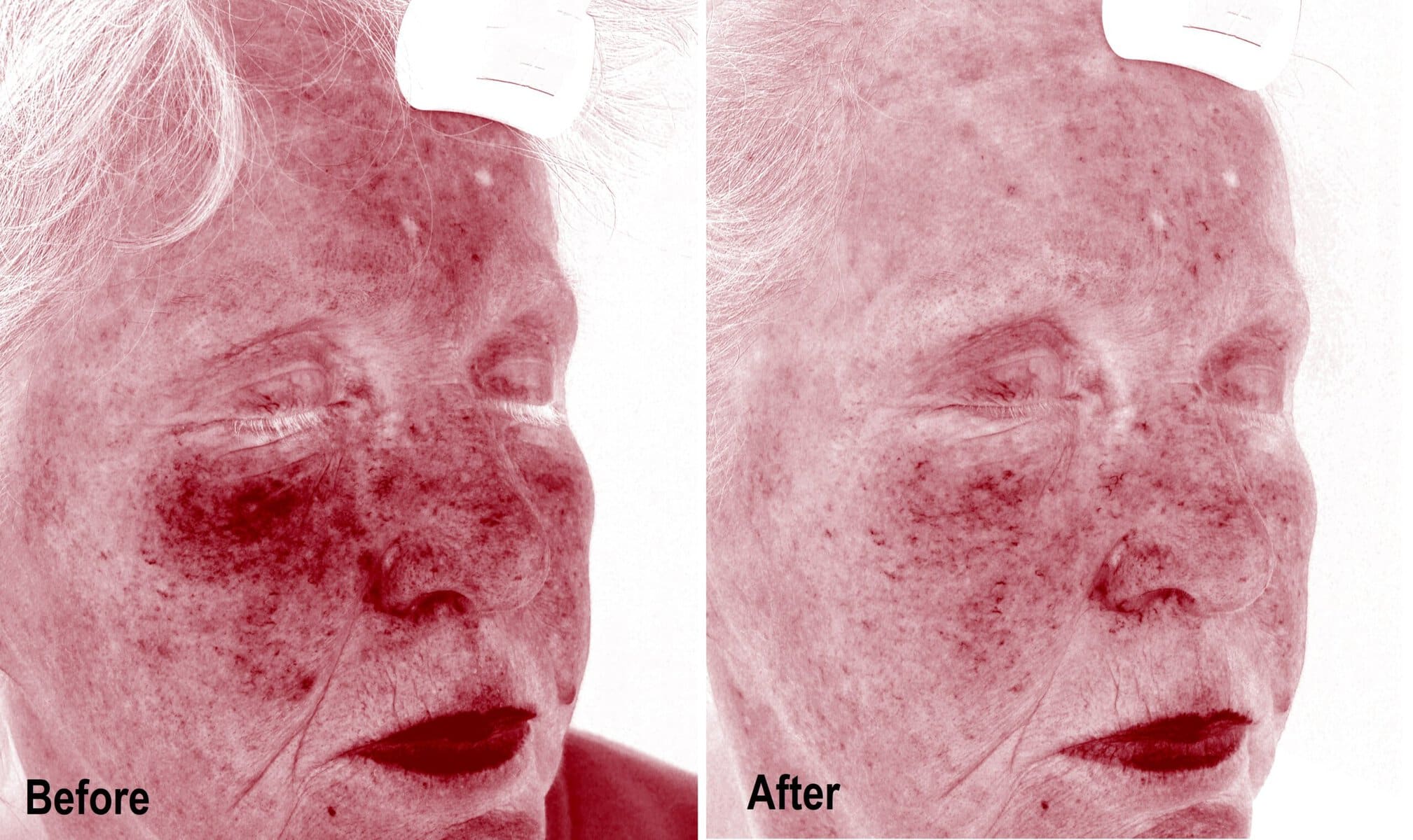 Enerpeel before and after