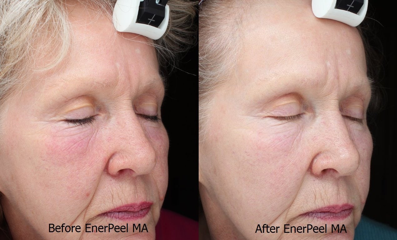 Enerpeel before and after