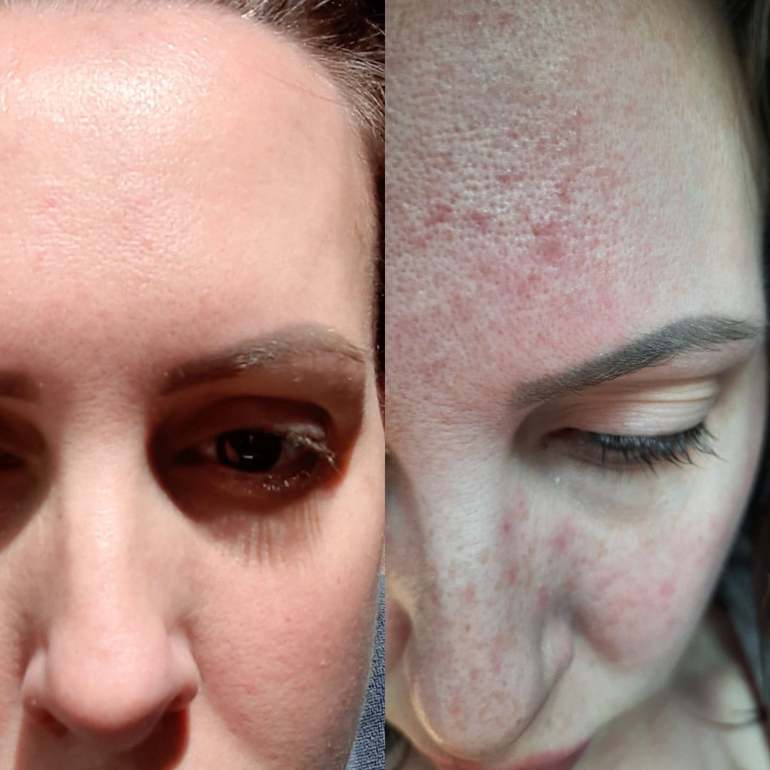 Enerpeel before and after