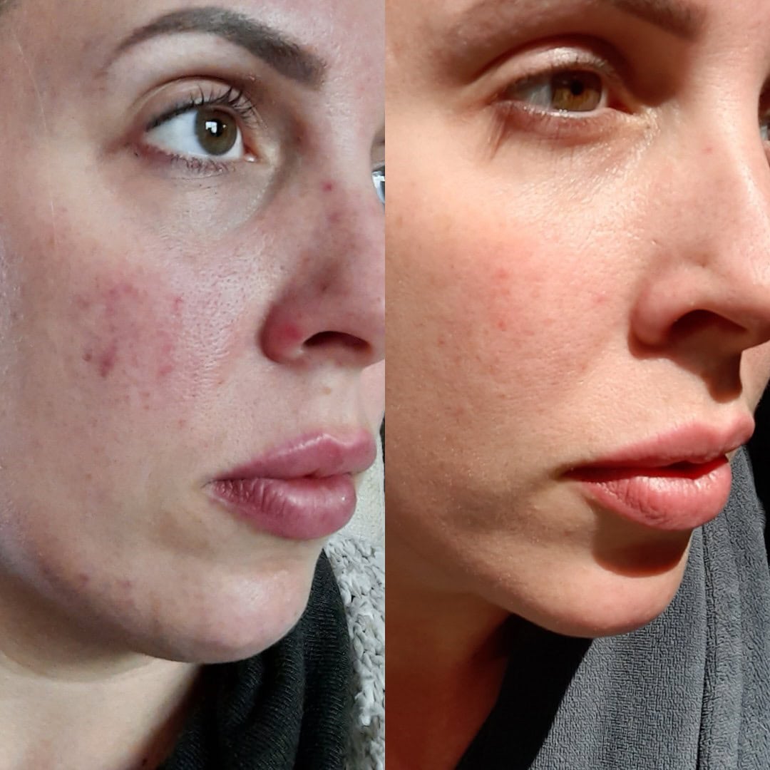 Enerpeel before and after