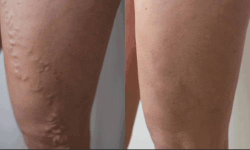 River Aesthetics | Varicose Veins Treatment | The Private Clinic