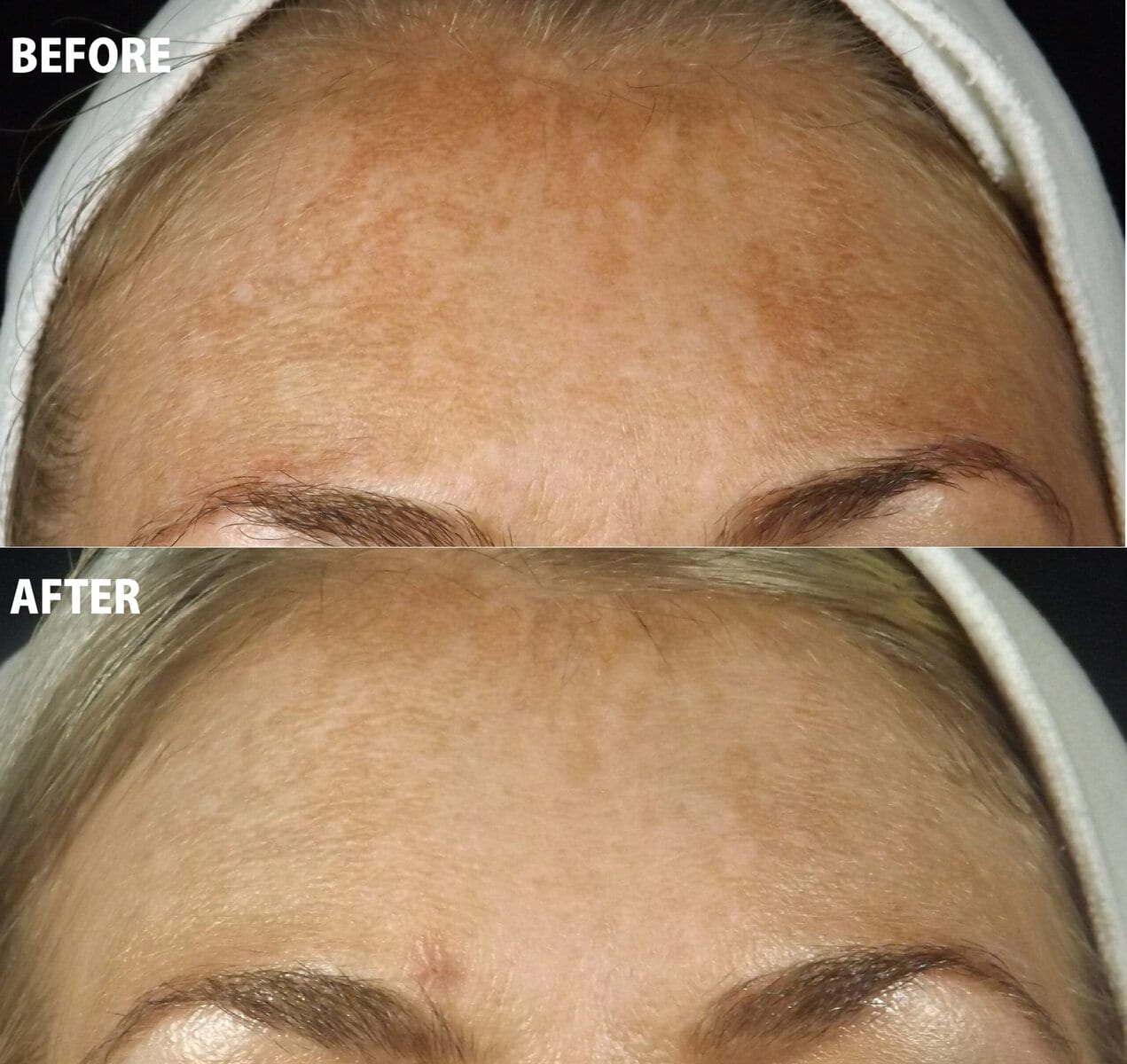 Enerpeel before and after