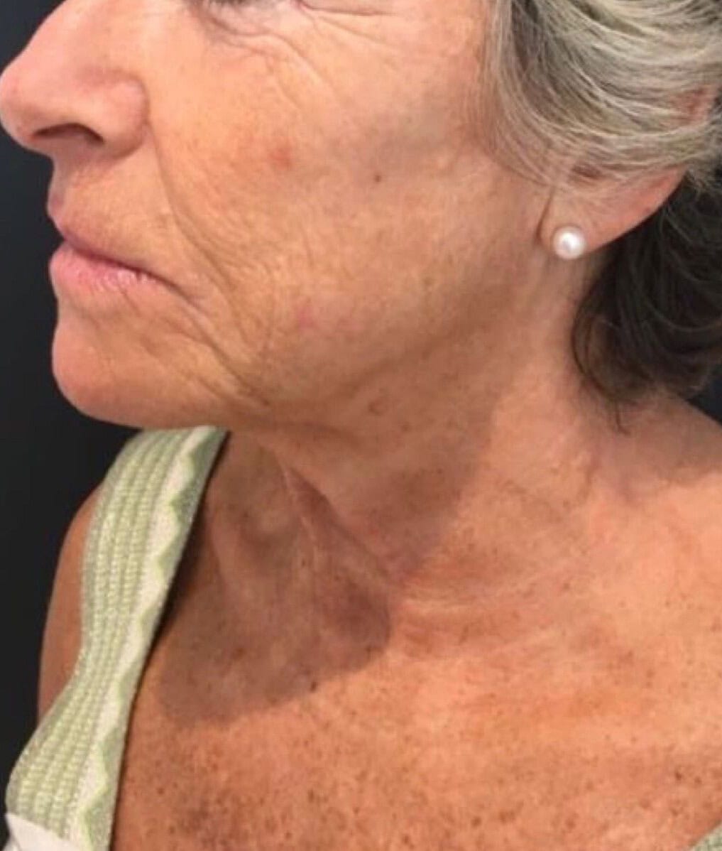 Ellanse | After photo | River Aesthetics