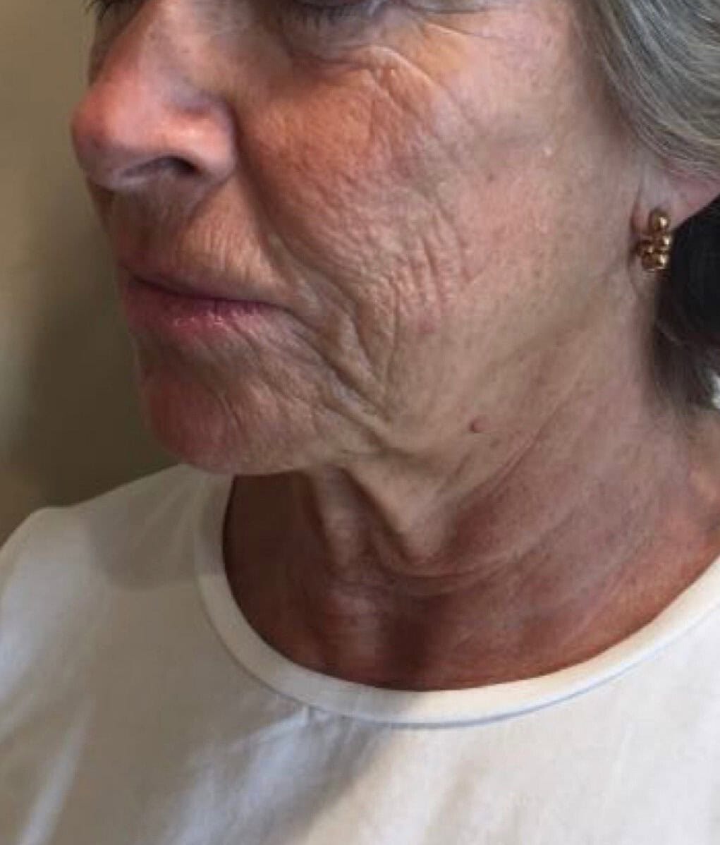 Ellanse | Before photo | River Aesthetics